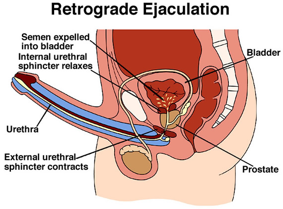 Combien d’éjaculations par mois pour diminuer les risques de cancer de la prostate ?