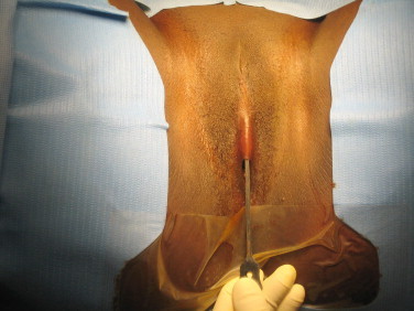 Figure 2. Excision de type III ou infibulation.