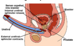 Combien d’éjaculations par mois pour diminuer les risques de cancer de la prostate ?